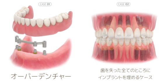 全ての歯、ほとんどの歯を失った場合