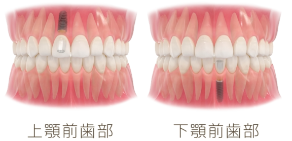 前歯を失った場合