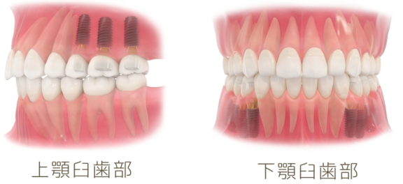 奥歯を失った場合